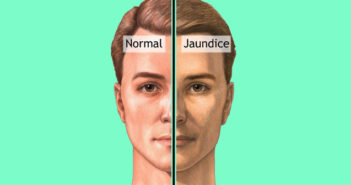 Jaundice Treatment