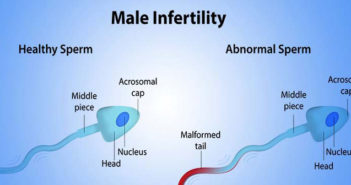 Male Infertility Treatment